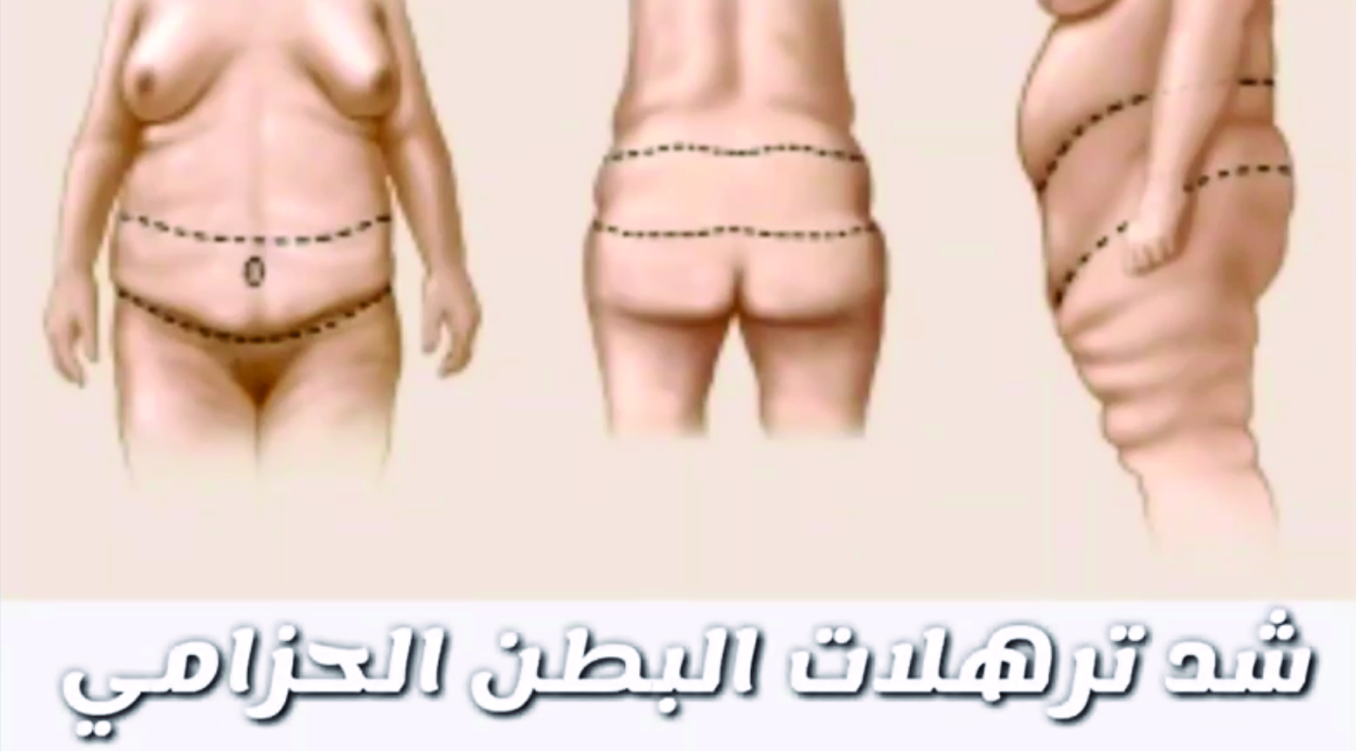 عملية شد البطن وشد الظهرbelt abdominolasty 